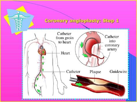 Nursereview Org Angioplasty Vs Bypass