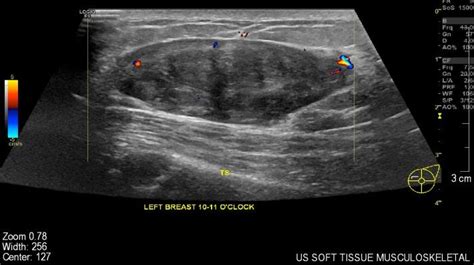 An Ultrasound Of The Breast Showing A Well Defined Hypoechoic Lesion Download Scientific