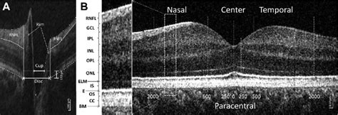 Horizontal Spectral Domain Optical Coherence Tomography Sd Oct B Scan