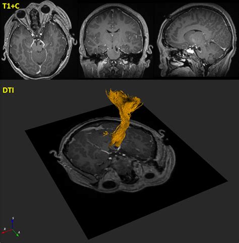 Postoperative Magnetic Resonance Imaging Showing Near Total Resection