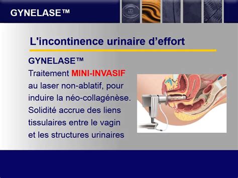 Traitement Laser De Lincontinence Urinaire De La Femme Youtube