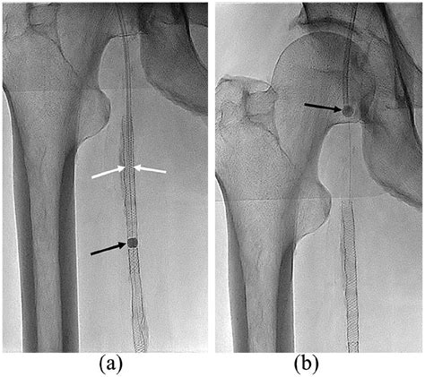 Safety And Efficacy Of Mynx Vascular Closure Device For The Closure Of