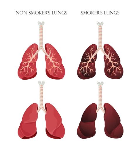 Premium Vector Illustration Of Normal Healthy Lungs And Lungs Smoker