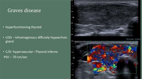 Imaging Of Thyroid