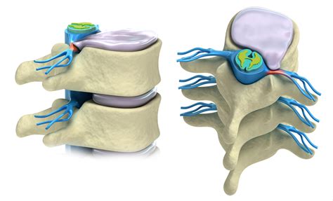 How Chiropractic Care Helps Disc Herniation The Accident Doctors