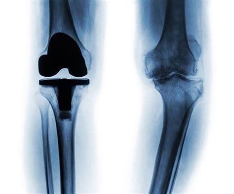 Total Joint Replacement - Los Angeles Orthopedic Group