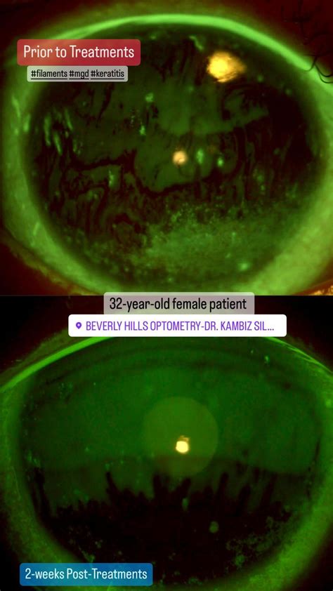 Case Presentation Year Old Female With Severe Dry Eye Disease