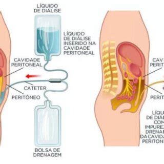 Como é feita a Diálise Peritoneal Download Scientific Diagram