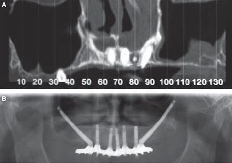 Figure 4 from The use of zygomatic implants for prosthetic ...