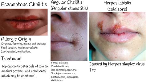 Dry And Cracked Lips Understanding Chapped Lips Lips Lesion Types