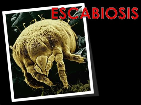 Escabiosis Dermatología