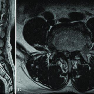 Perioperative Imaging For The First Operation A Lateral Radiographs