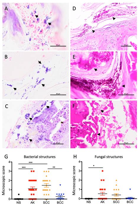 Abundant Microbial Structures Are Prevalent In Actinic Keratosis Ak Download Scientific