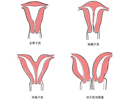 双子宫是什么情况久久健康网