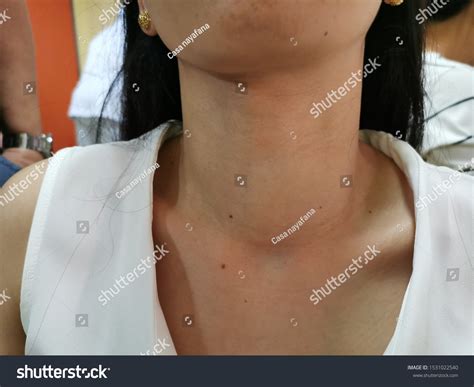 Diffuse Thyroid Swelling Goitre Cause Hypothyroidism Foto De Stock