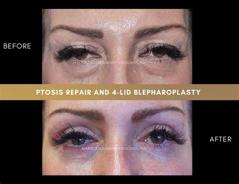 Ptosis Repair Photos - Plastic Eye Surgery Associates