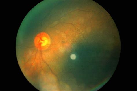 Diabetes Associated With Significantly Higher Risk Of Retinal Vein Occlusion Ophthalmology Advisor