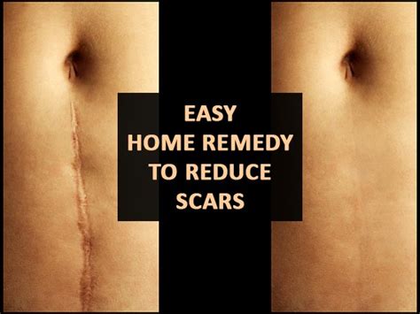 Try This Powerful Home Remedy To Reduce Injury Scars