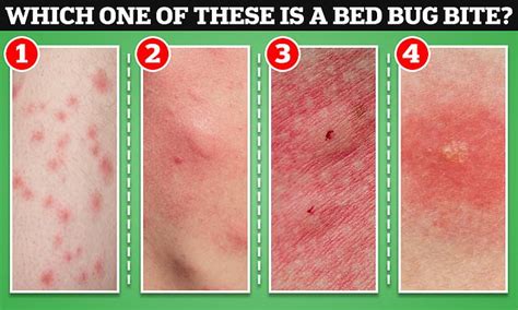 Bed Bug Vs Flea Bites