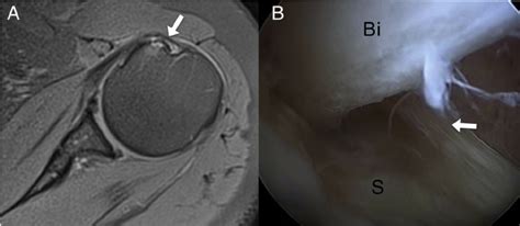 Unstable Long Head Of The Biceps A Mri Arrow Subluxated Biceps B