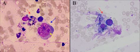 Frontiers Case Report Parvovirus B19 Infection Complicated By