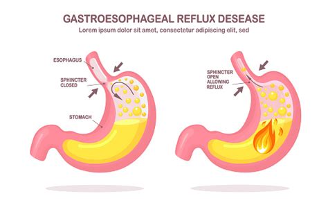 Ilustración De Estómago Humano Enfermedad Por Reflujo Gastroesofágico