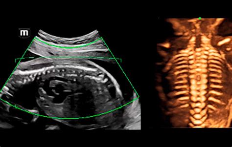 Enabling A Pathway To High Quality Ultrasound Diagnosis For Women Mindray