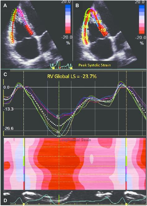 Peak Systolic Longitudinal Strain Of The Right Ventricular Rv Free