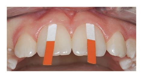 The Gingival Crevicular Fluid Collection With Endodontic Paper Points