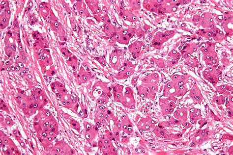 Filefibrolamellar Hepatocellular Carcinoma High Mag Wikimedia