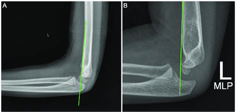 Anterior Humeral Line