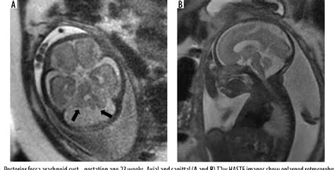 Figure 1 From Imaging Spectrum Of Posterior Fossa Anomalies On Foetal