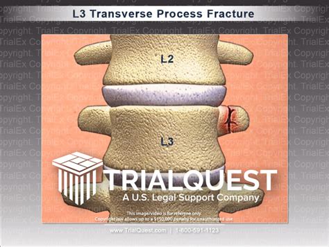 L3 Transverse Process Fracture Trialexhibits Inc