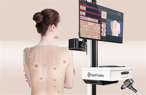 Digital Mole Mapping