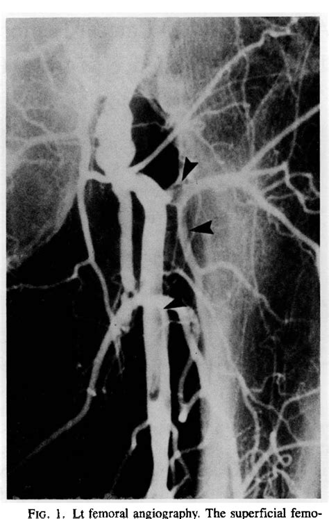 Figure 1 From Angiographic Anatomy Of The Lateral Femoral Circumflex