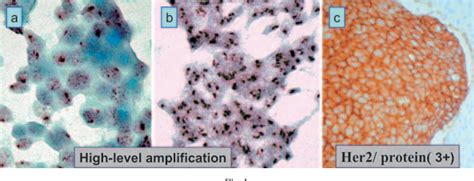 Figure 1 From Basic Examination Of Her 2neu In Breast Carcinoma By