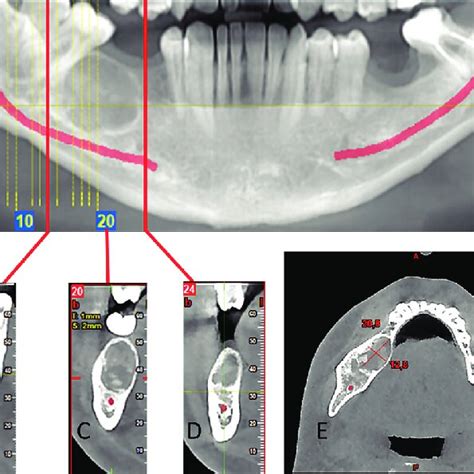 Panoramic View A Cross Sections On Cbct Scans Of The Tumor B D