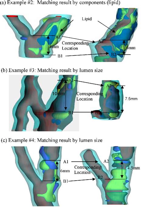 Figure 1 From Patient Specific Artery Shrinkage And 3D Zero Stress