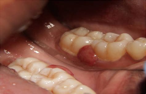 Laser Removal Of Pyogenic Granuloma