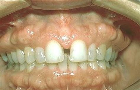 Exostosis - of Foot, Mouth, Ear, Definition, Pictures | HubPages