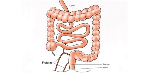 SURGERY BECAUSE OF A FISTULA IN CROHNS DISEASE Nutrition 4 IBD