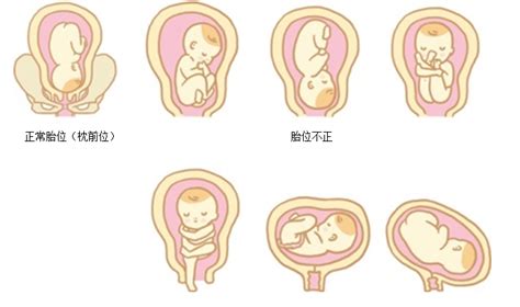 胎位不正症状病因治疗方法鉴别专家咨询丁香医生