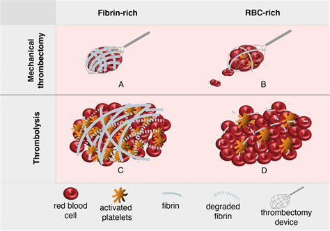 Comparing Difference In Acute Ischemic Stroke Treatment Between