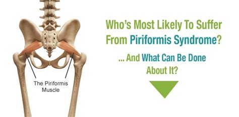 Piriformis Syndrome A Pain In The Butt And Hip And Leg — Preferred Physical Therapy