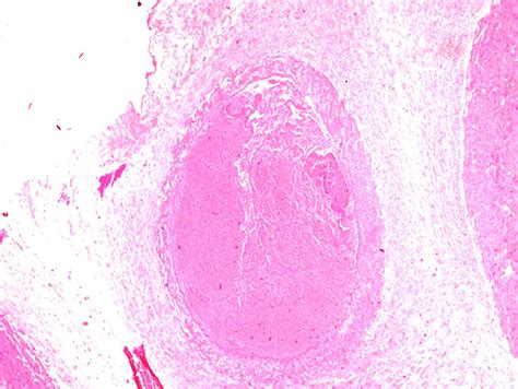 Fibrinoid Necrosis In The Arterial Wall The Arterial Lumen Is Filled Download Scientific