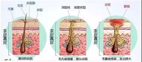 痘疤形成原因有哪些？如何有效治疗？凤凰网