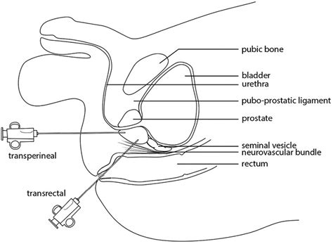 Panel Discussion Transrectal Vs Transperineal Biopsy For Detecting Prostate Cancer American