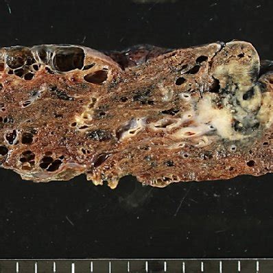 Gross Findings Of The Surgically Resected Specimen Of The Right Upper