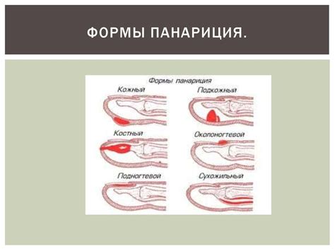 Панариций. Классификация панариций - презентация онлайн