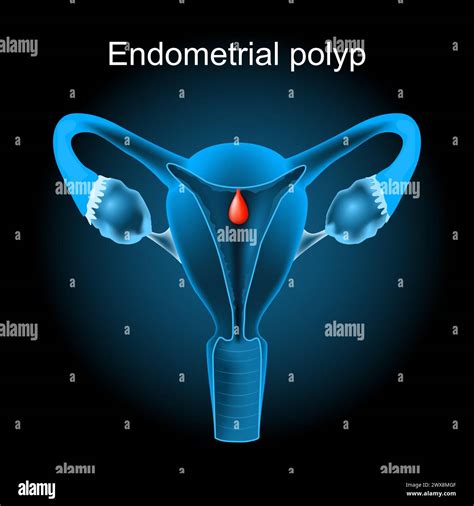 Endometrial Hyperplasia Banque Dimages Vectorielles Alamy